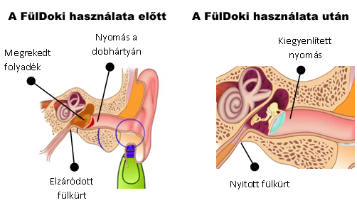 A FülDoki használata előtt és után